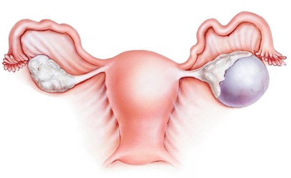 Chirurgie du kyste de l'ovaire – Gynecomenton.fr